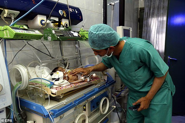 У Ємені народилися рідкісні сіамські близнюки з одним тілом на двох
